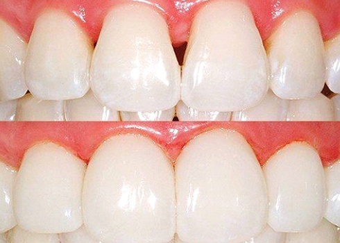 before and after BioClear