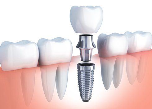Animation of implant supported dental crown placement