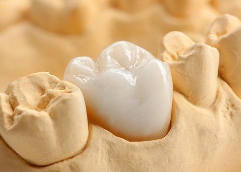 Closeup of smile model with dental crown restoration