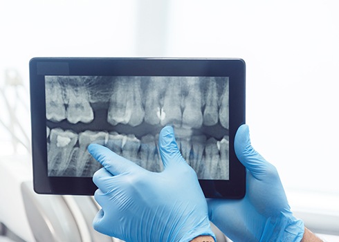 Digital dental x-rays